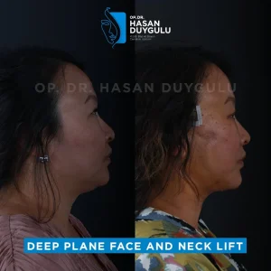 Galerija podizanja vrata u Turskoj i fotografije pre i posle