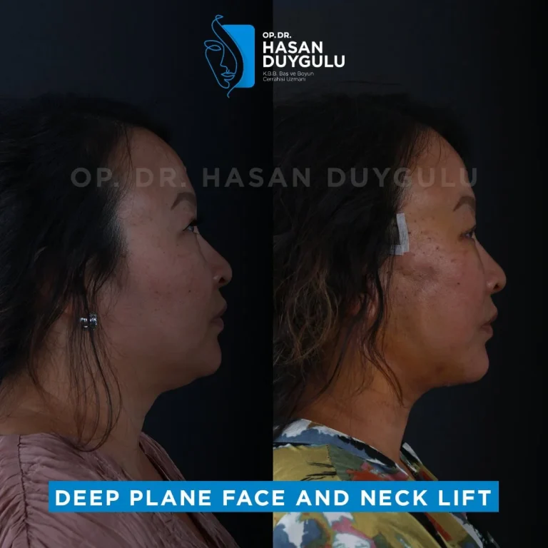 face-lift-before-and-after-turkey-istanbul