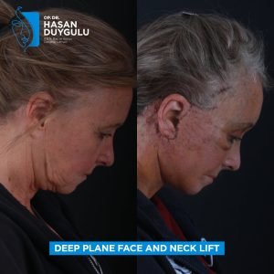 Фотографије пре и после подизања лица у Турској