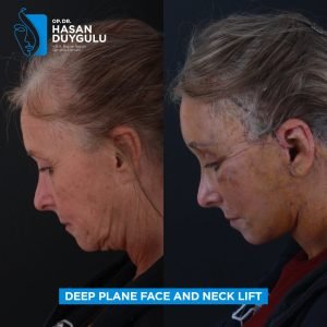 Фотографије пре и после подизања лица у Турској
