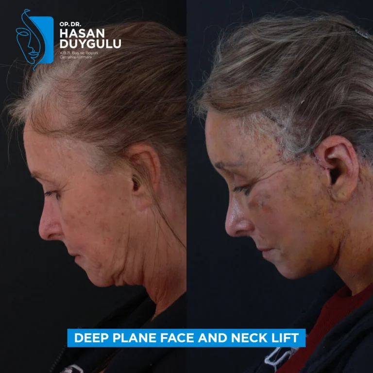 face-lift-in-turkey-after-photo