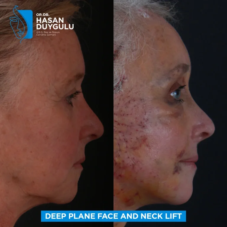 face-lift-in-turkey-after-photos