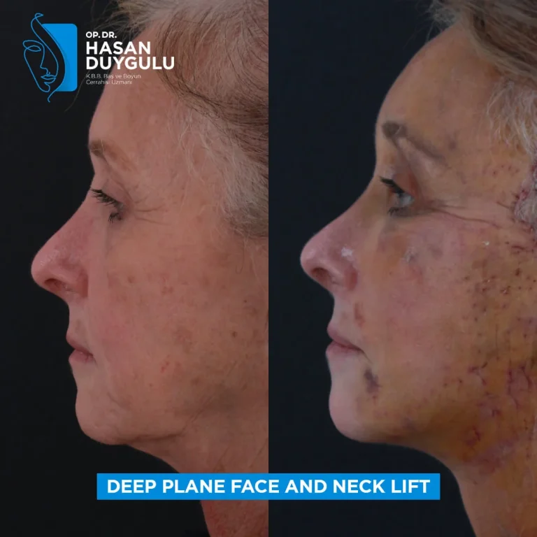 face-lift-in-turkey-before-photos