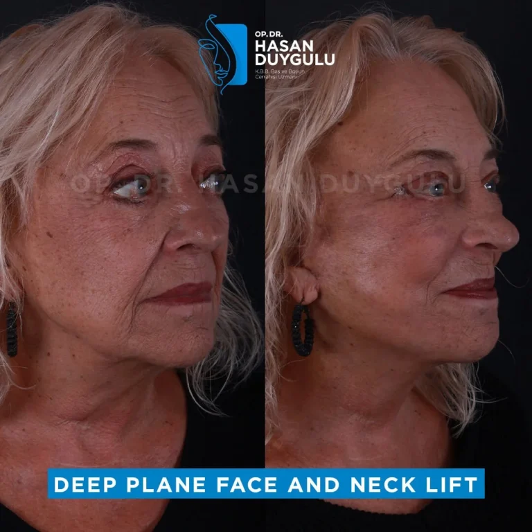 face-lift-turkey-before-after