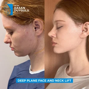 Galerija podizanja vrata u Turskoj i fotografije pre i posle