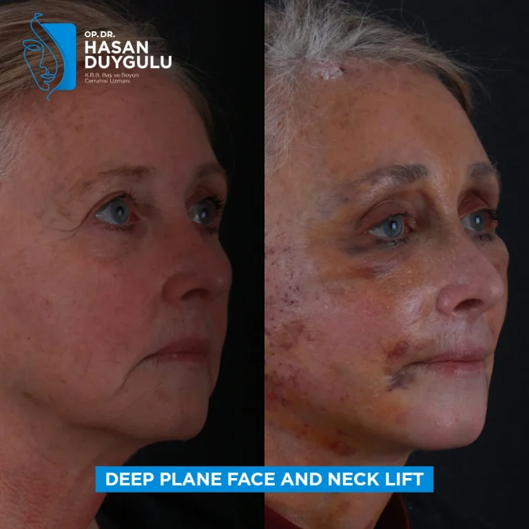 facelift-in-istanbul-photos