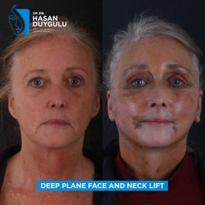 Фотографије пре и после подизања лица у Турској