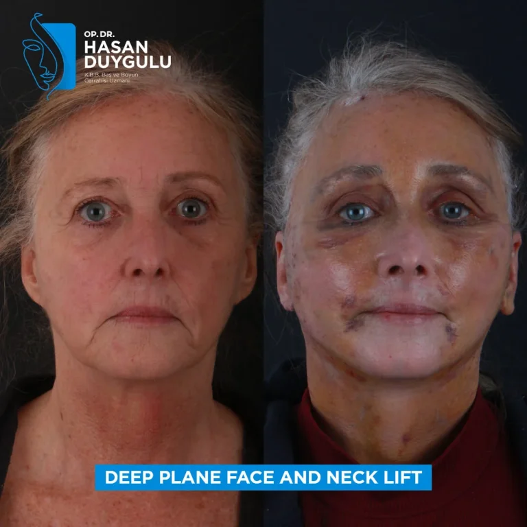 facelift-in-turkey-after-photos