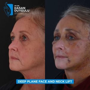 Фотографије пре и после подизања лица у Турској