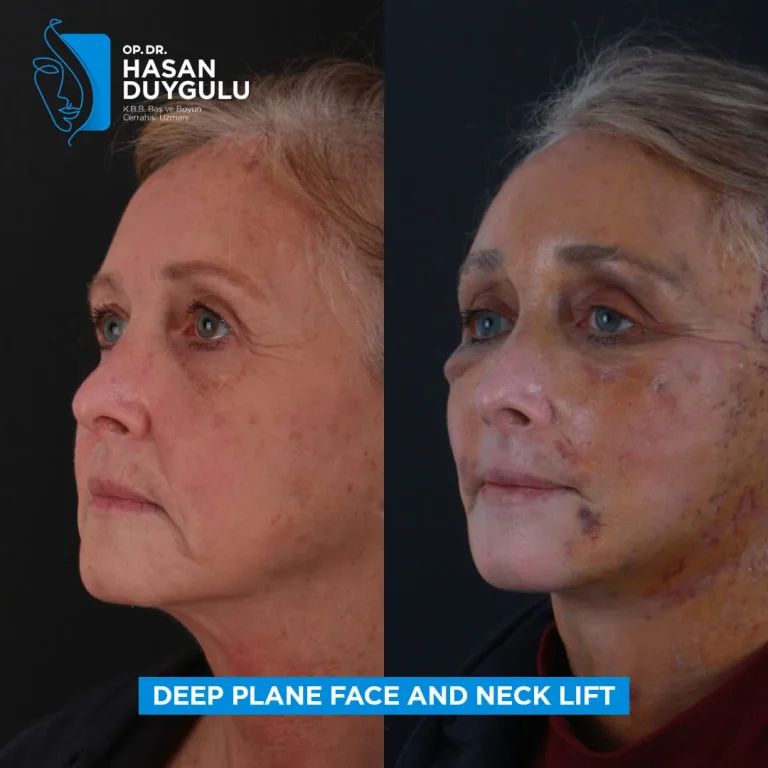 facelift-in-turkey-photos