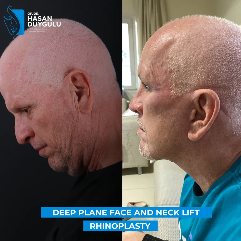 facelift-turkey-before-and-after