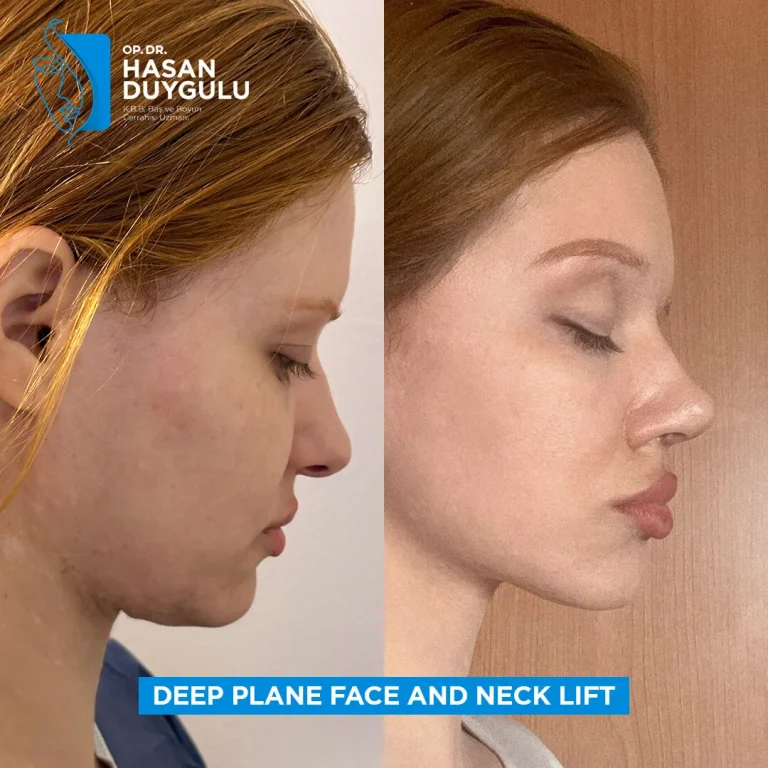 facelift-woman-in-istanbul