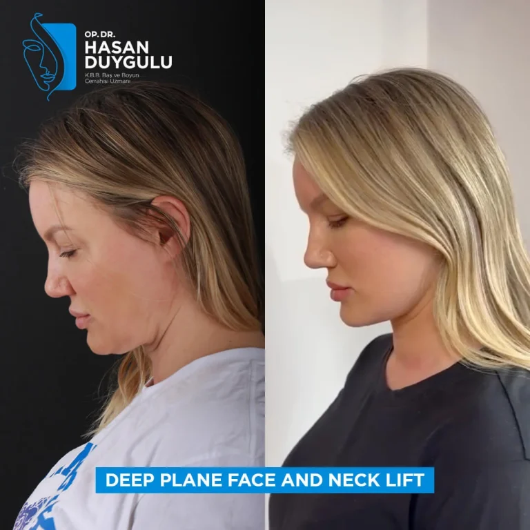 facelift-woman-in-turkey