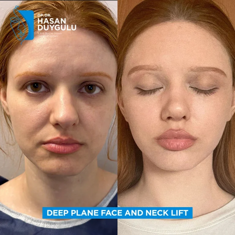 Facelift surgery in Turkey