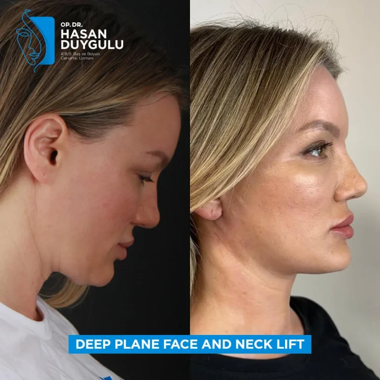 facelift-women-in-turkey