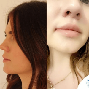 lifting-usana-žena-u-turskoj