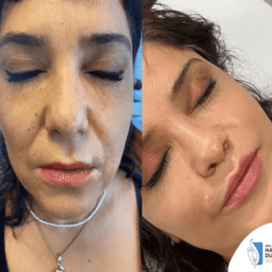 podizanje-usana-zene-u-istanbulu