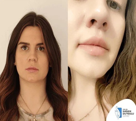 podizanje-usana-turska-sa-dr-hasanom-dujguluom