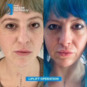 lifting-usana-žena-u-turskoj