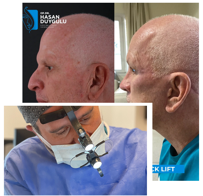 Podizanje vrata Turska