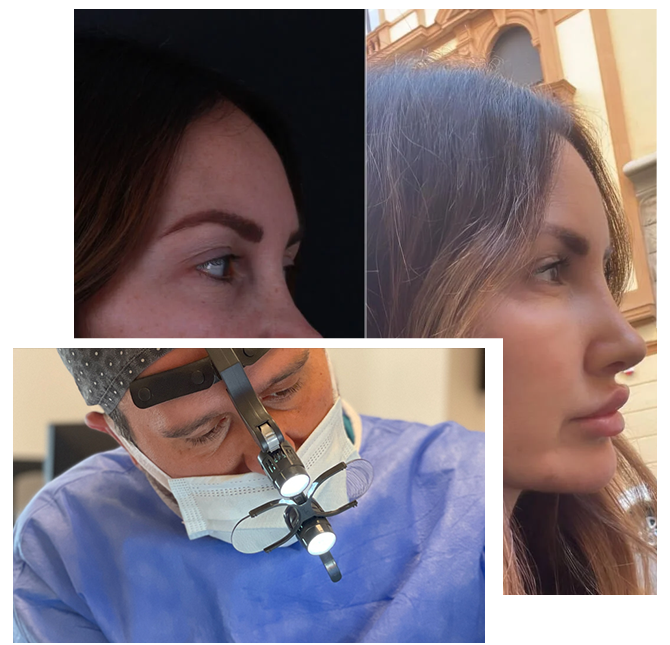 Reviziona rinoplastika u Turskoj