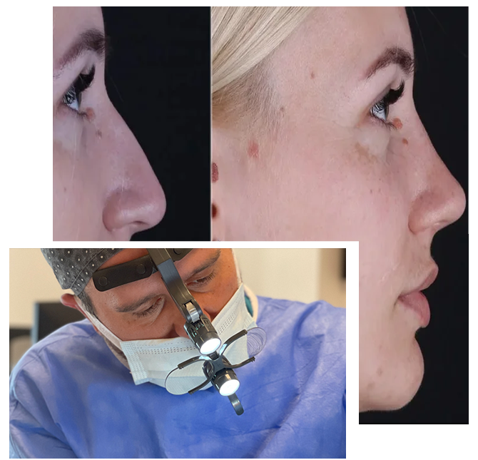 Rinoplastika u Turskoj