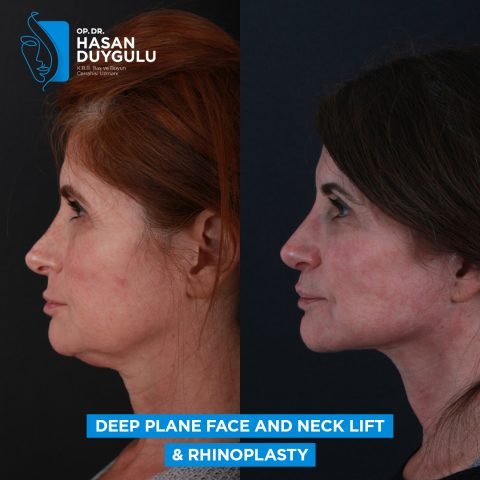 žene duboko ravno podizanje lica