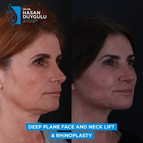 Duboko ravno podizanje lica i vrata