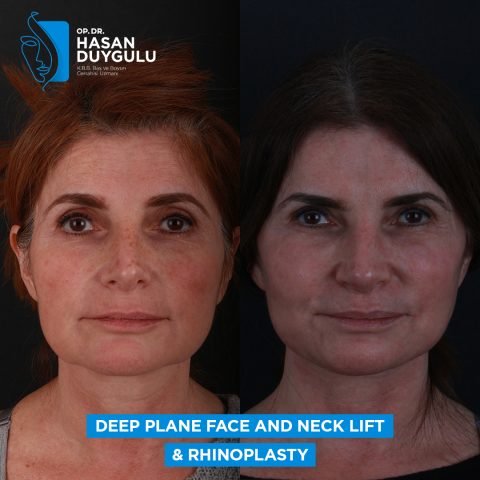 rinoplastika pre posle žena