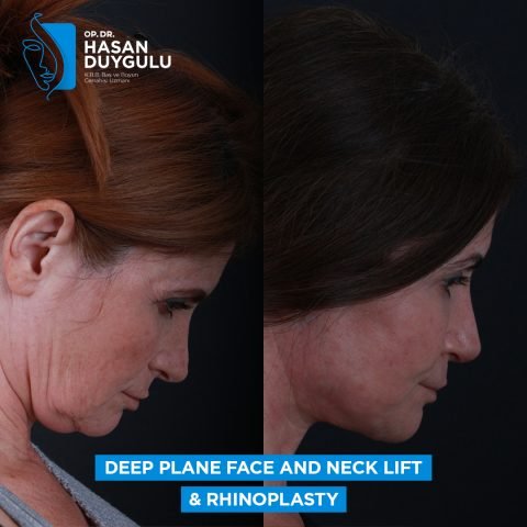 žensko podizanje vrata pre posle