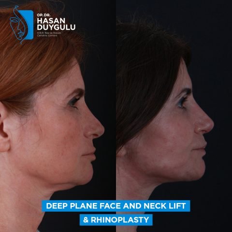 žensko podizanje vrata u turskoj