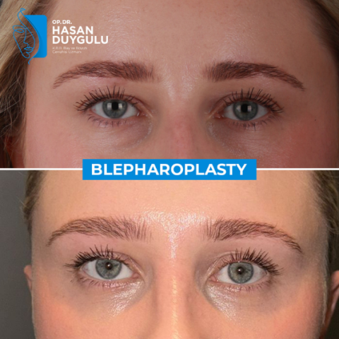 blepharoplasty-turkey-with-dr-hasan-duygulu