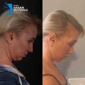 фејслифт-пре-и-после-фотографије-турска