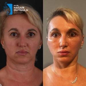 лифтинг-лица-у-истанбулу