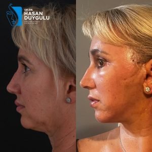 лифтинг-лица-у-турској
