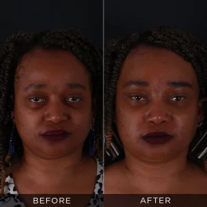 Fotografije pre i posle operacije lisičjih očiju u Turskoj