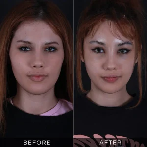 Fotografije pre i posle operacije lisičjih očiju u Turskoj