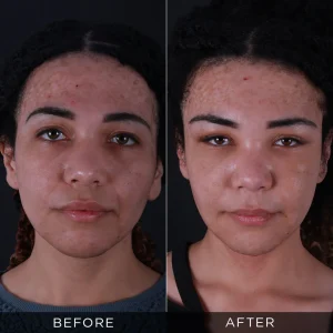 Fotografije pre i posle operacije lisičjih očiju u Turskoj