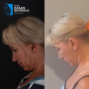женски-фејслифт-пре-и-после-турска