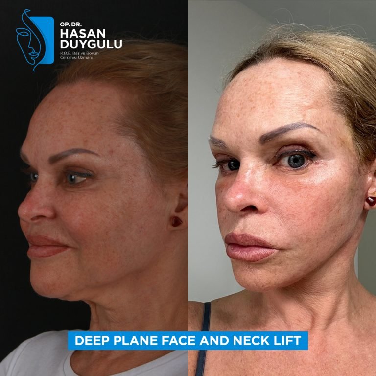 women-facelift-turkey