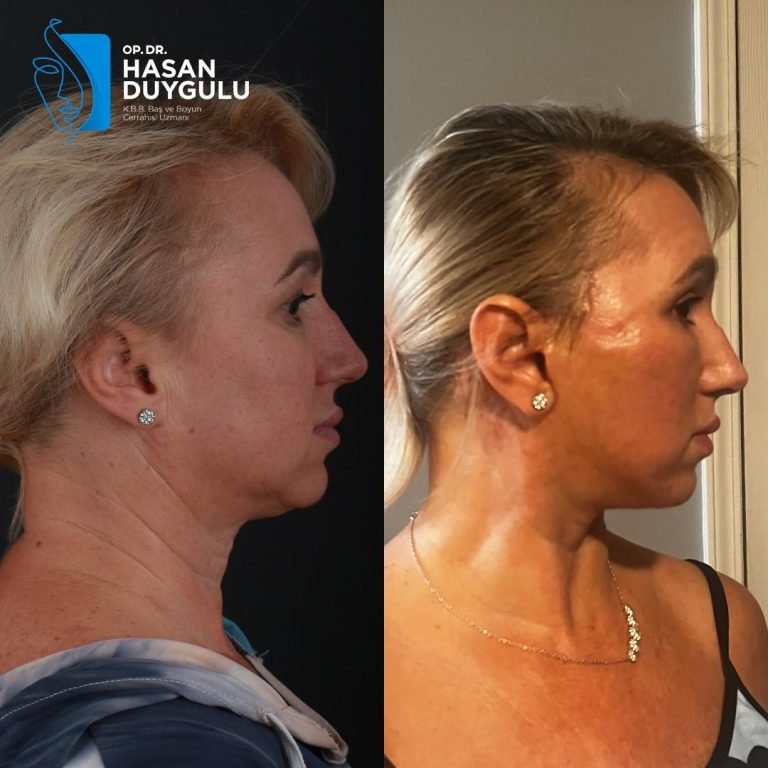 women-facelift-turkey-istanbul
