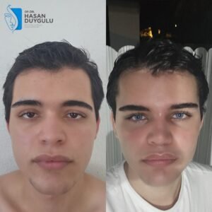 Fotografije pre i posle operacije lisičjih očiju u Turskoj