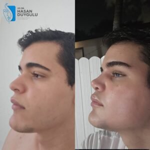 Fotografije pre i posle operacije lisičjih očiju u Turskoj