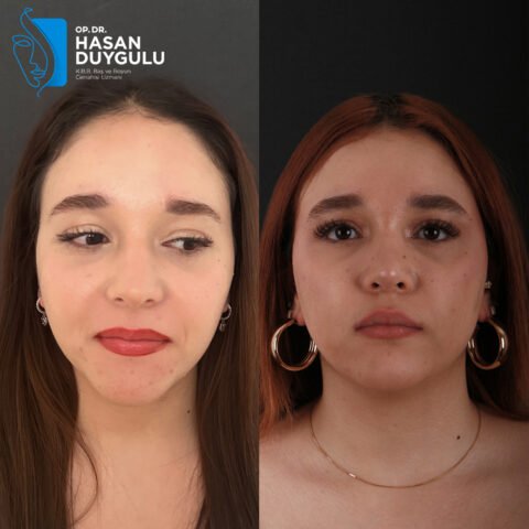 istanbul-rinoplastika-operacija