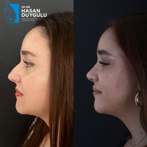 rinoplastika-faceaesthetics