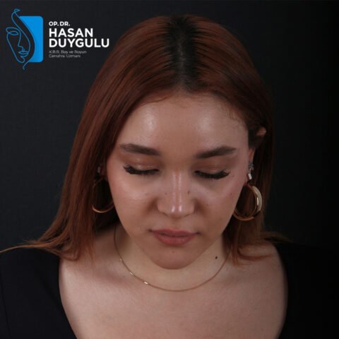 rinoplastika-istanbul-faceaesthetics
