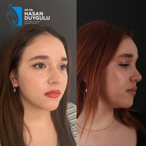 rinoplastika-operacija-turska-istanbul