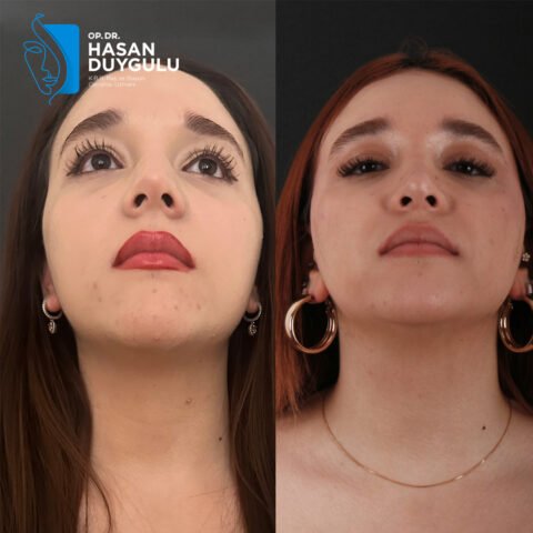 rinoplastika-turska-faceaesthetics