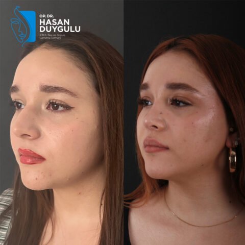 rinoplastika-turska-istanbul