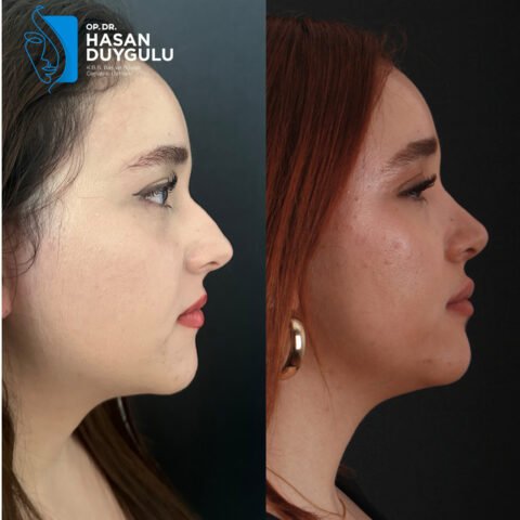 rinoplastika-operacija-turska